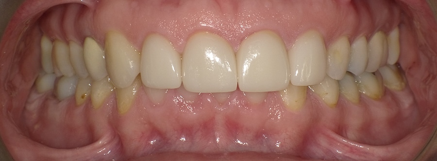DrFO_Case1_Invisalign_After1