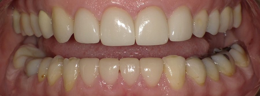 DrFO_Case3_Whitening_Veneers_Invis_After1