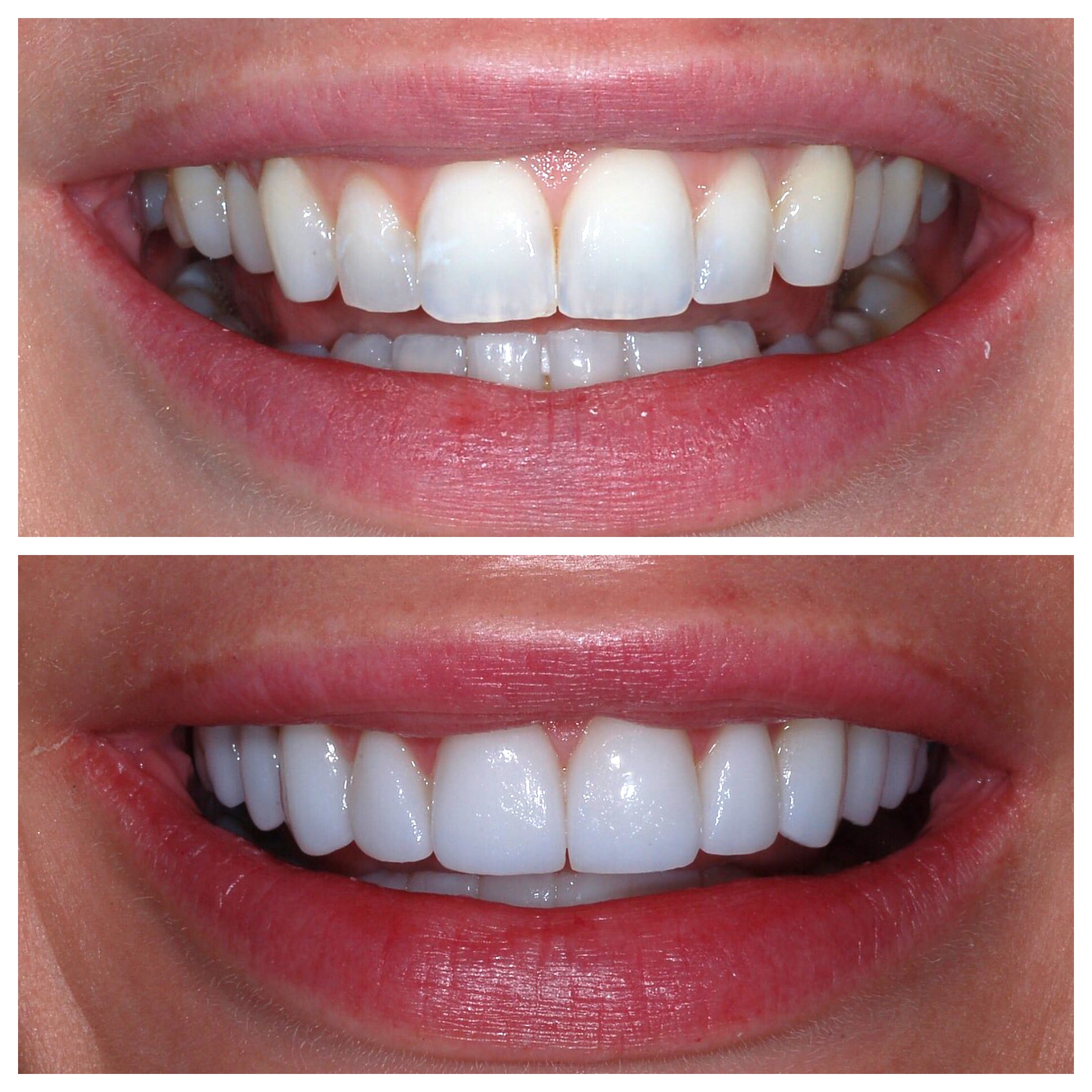 Veneers