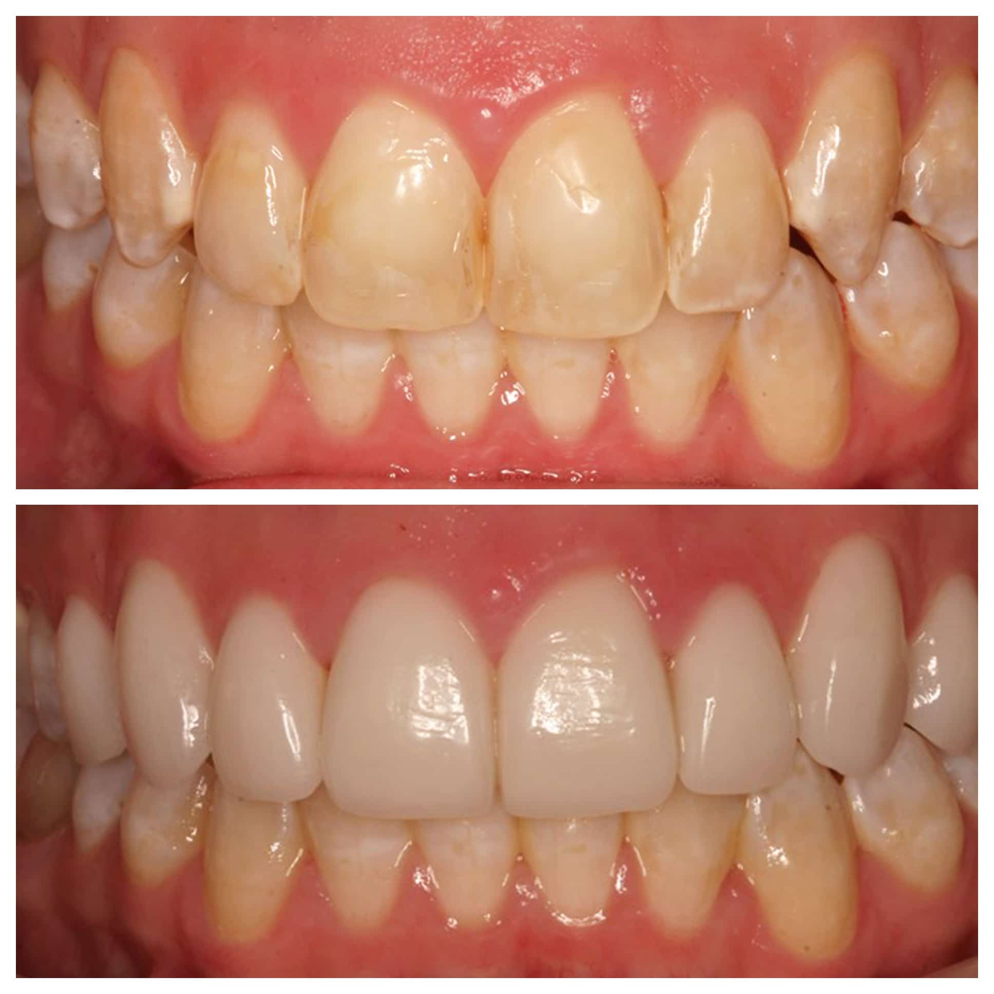 Veneers