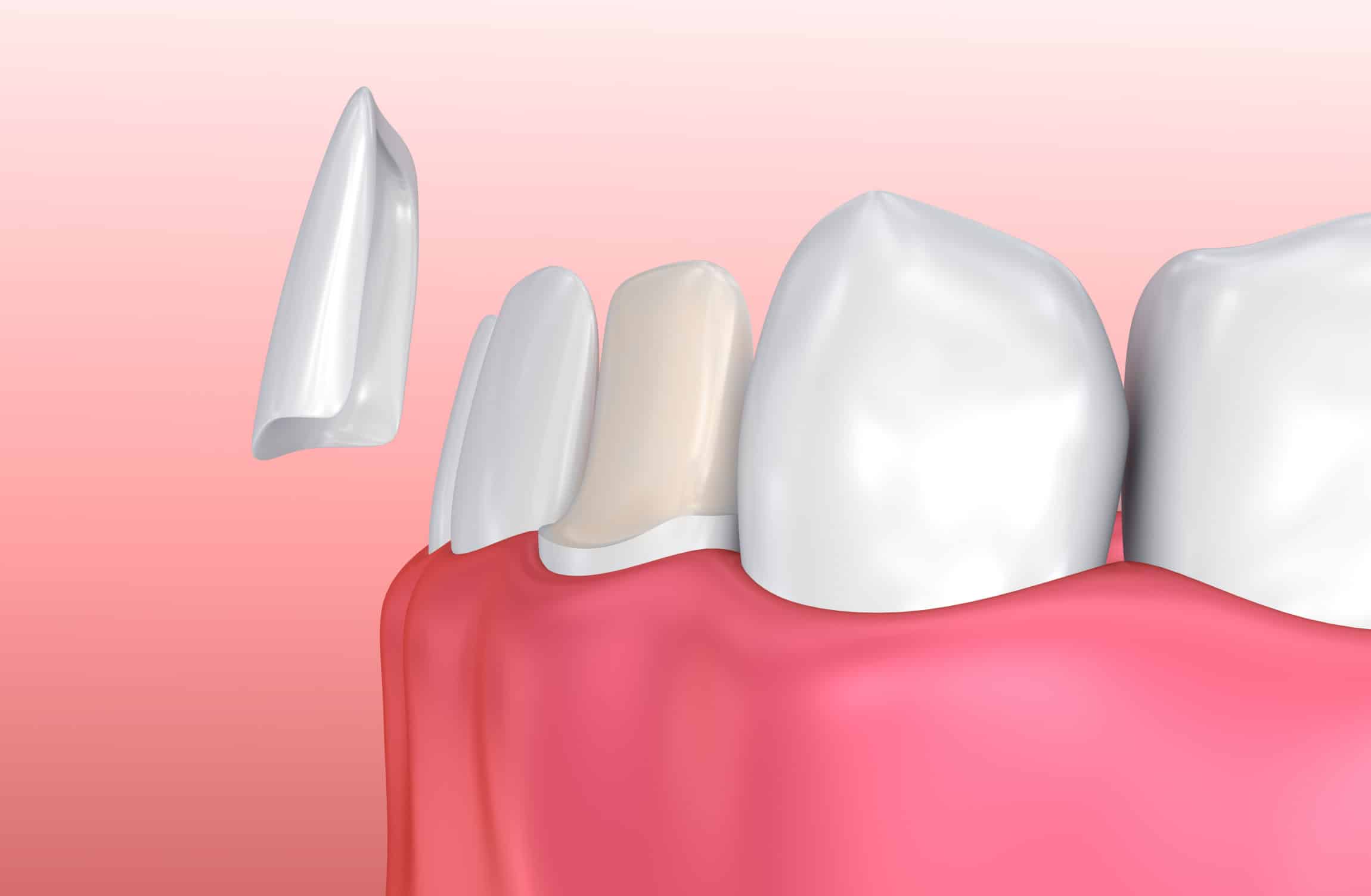 Dental Veneers: Porcelain Veneer installation Procedure. - Gallery 57