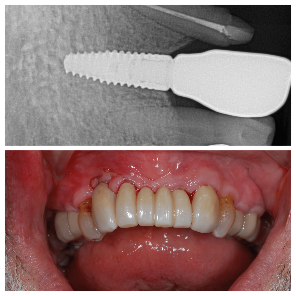 implants implants