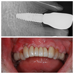 implants implants