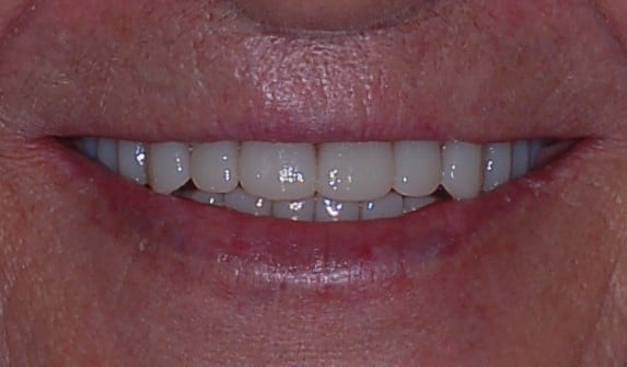 denture smile after
