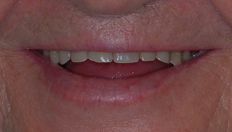 denture smile before1