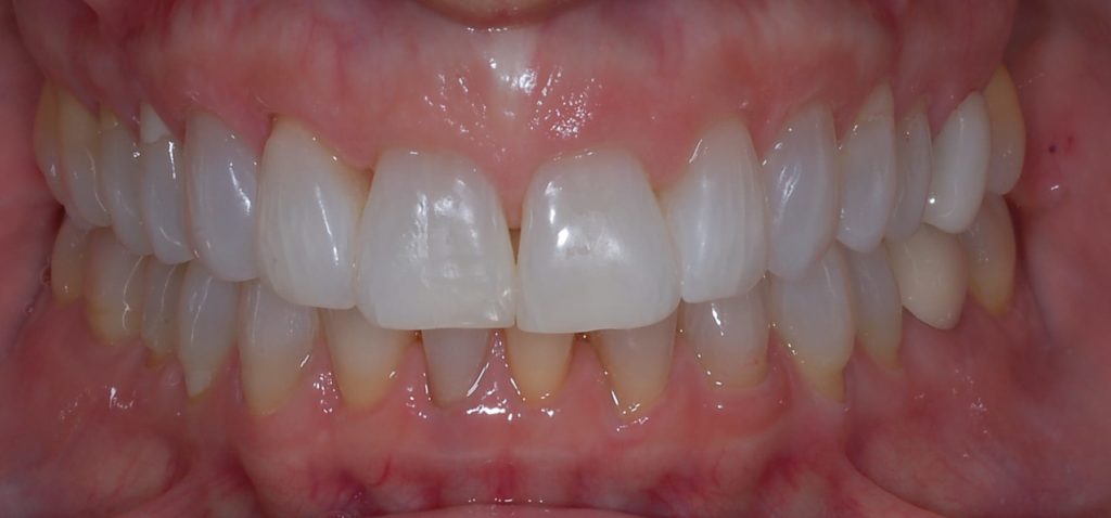 dr sam invis whitening after