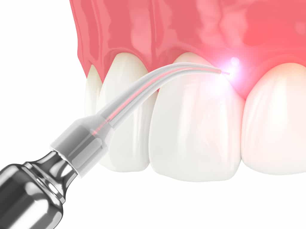 3d render of dental diode laser used to treat gums. The concept of using laser therapy in the treatment of gums