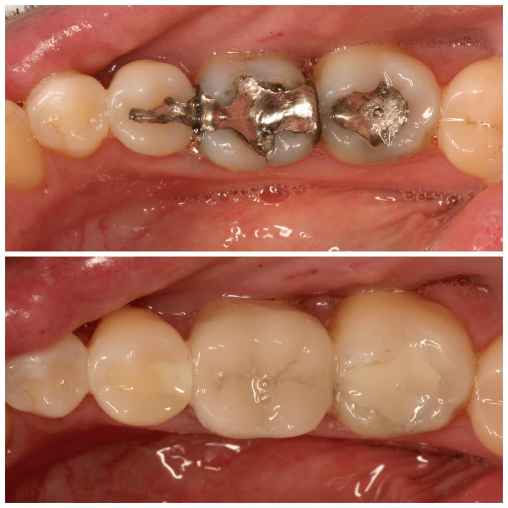Dr RR Same day crown and replace old silver with bonding