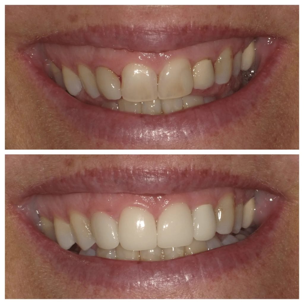 Crowns and Onlays Midtown Manhattan Dental Crowns NYC