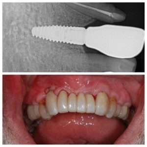 single tooth dental implant and set of teeth with implant in place