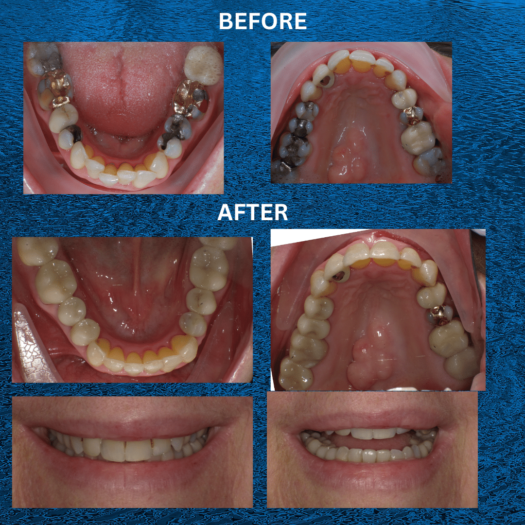 Invisalign - Before & After