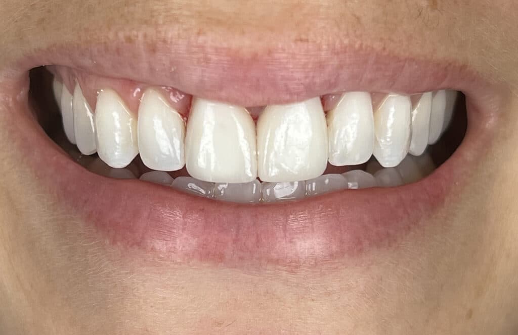 GP smile after
