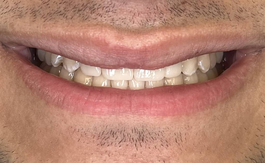 JM veneer, resin bonded bridge smile after