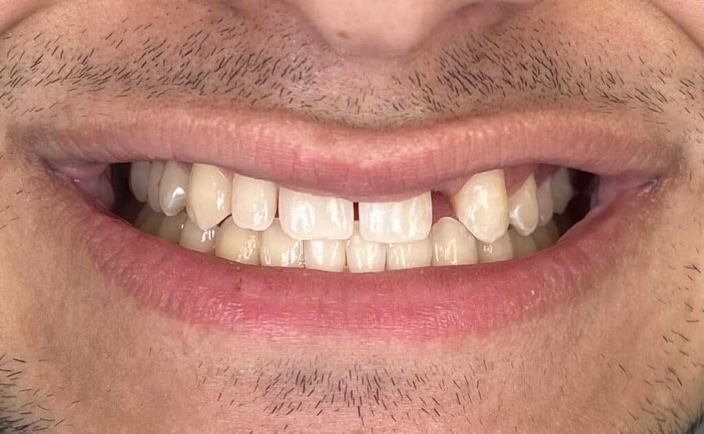 JM veneer, resin bonded bridge smile before