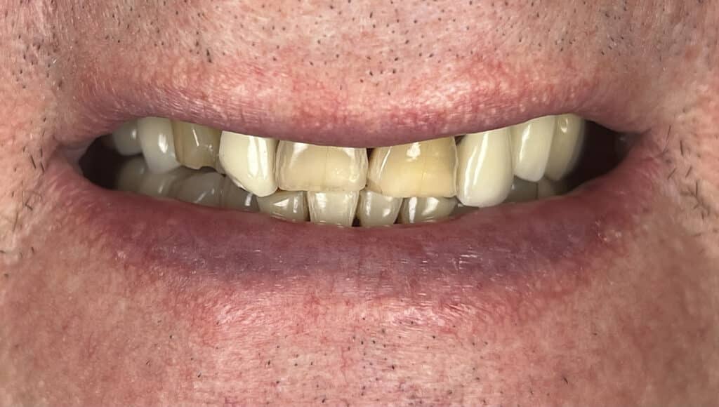 MR combo veneers and crowns 5 upper 6 lower1