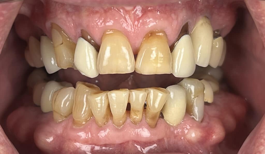 MR combo veneers and crowns 5 upper 6 lower2