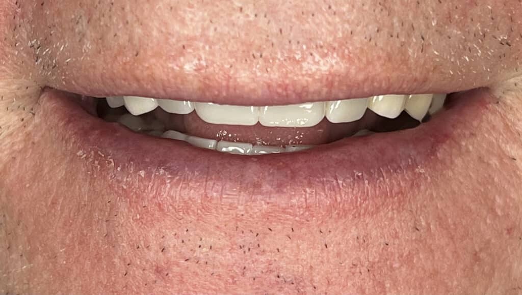 MR combo veneers and crowns 5 upper 6 lower3