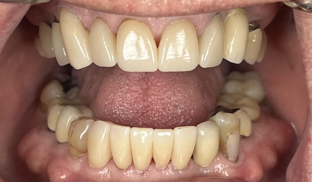 MR combo veneers and crowns 5 upper 6 lower4