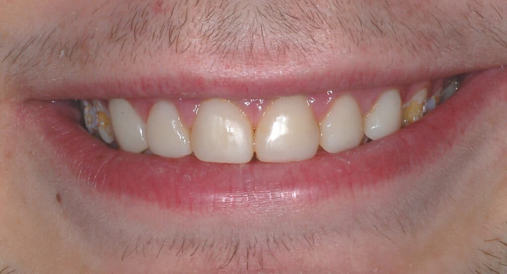 NR smile before