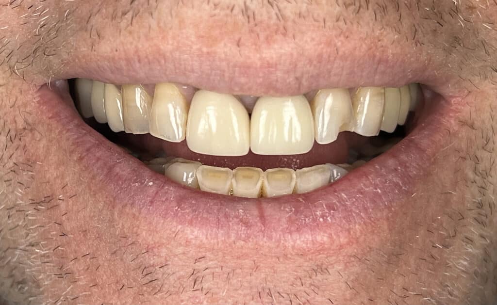 RH Smile before