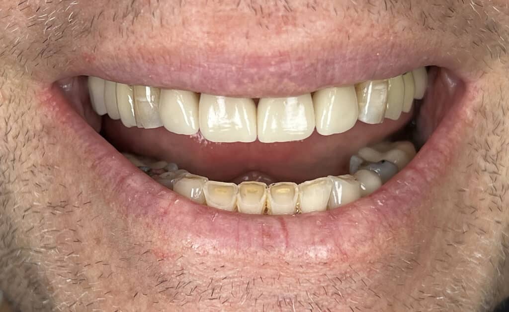 RH smile after