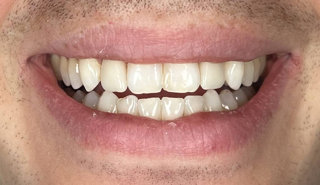 veneers on #7, 10 (laterals)
