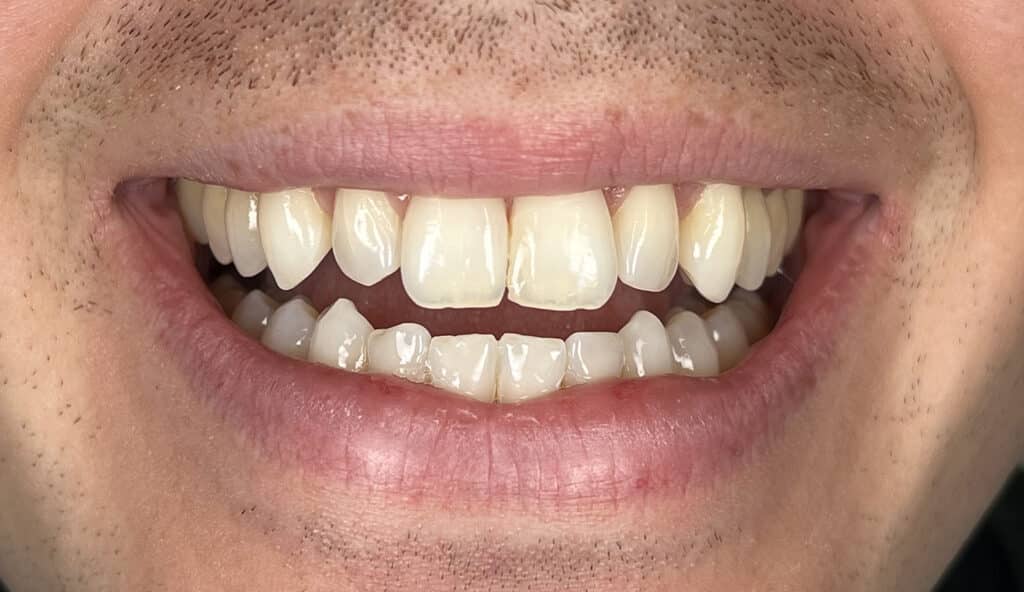 veneers on #7, 10 (laterals)